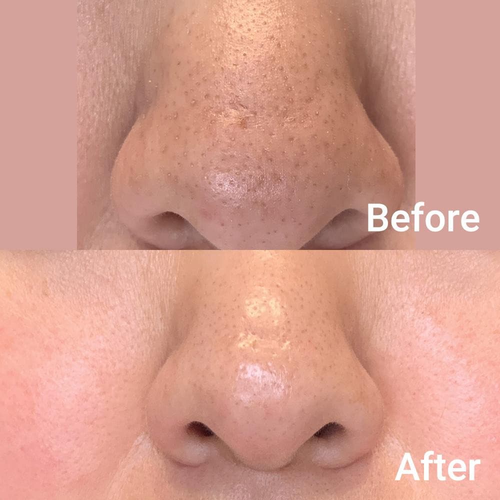 Medicube Zero Pore Pad 2.0 70P